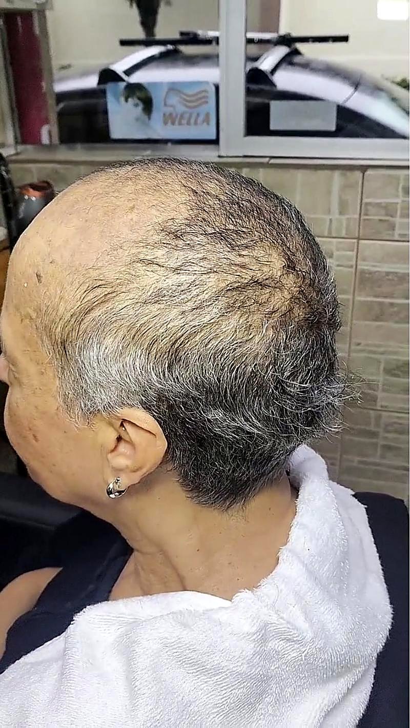 Cliente mulher antes, com rarefação no topo
