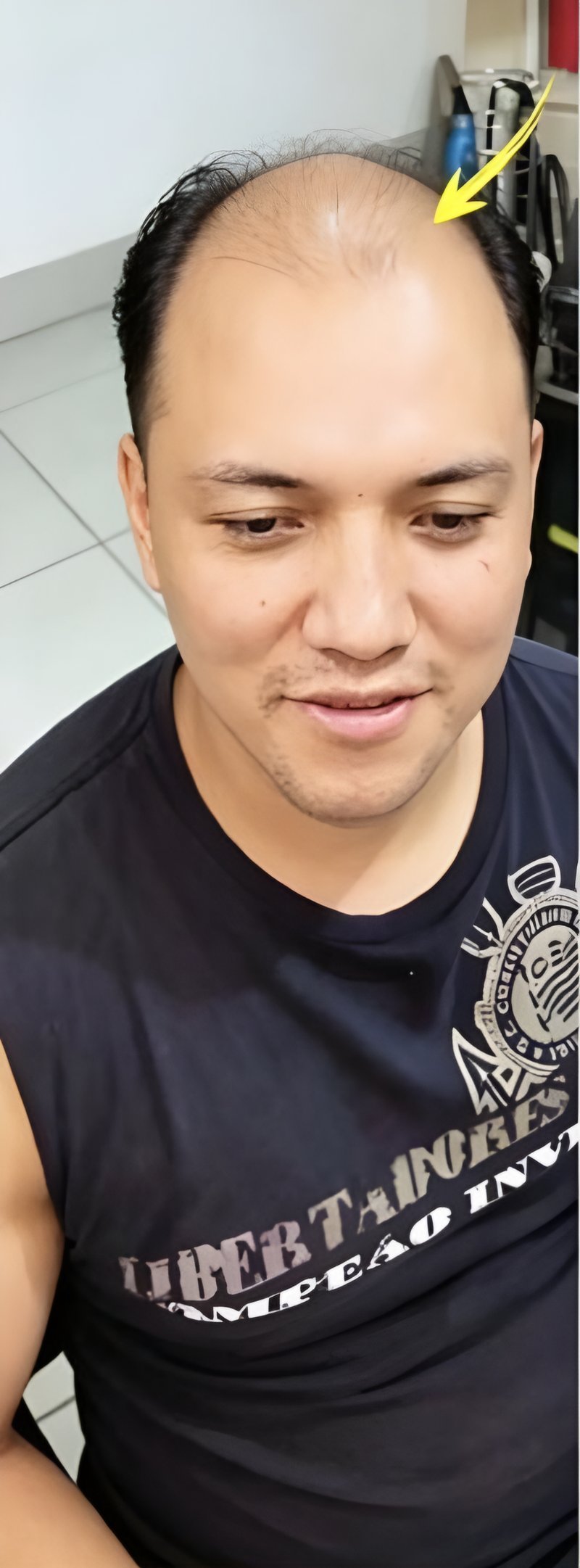 Cliente jovem antes, com entradas e topo ralo