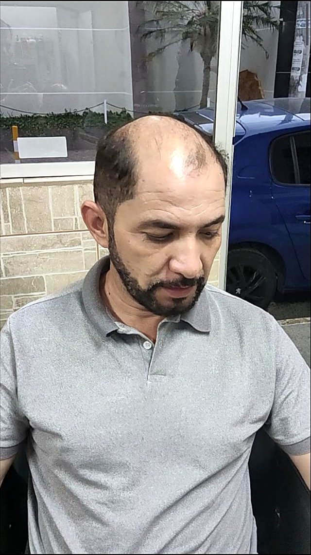 Cliente de frente antes, com calvície frontal